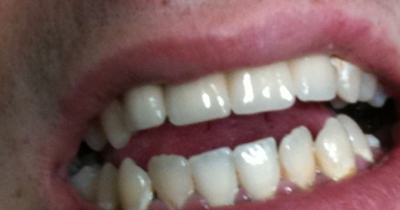 Leromlott fogak kezelése után porcelán híd
