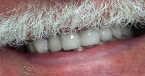 Zahnersatz von fehlenden Zähnen mit Zahnbrücke aus Ivoclar Porzellan.